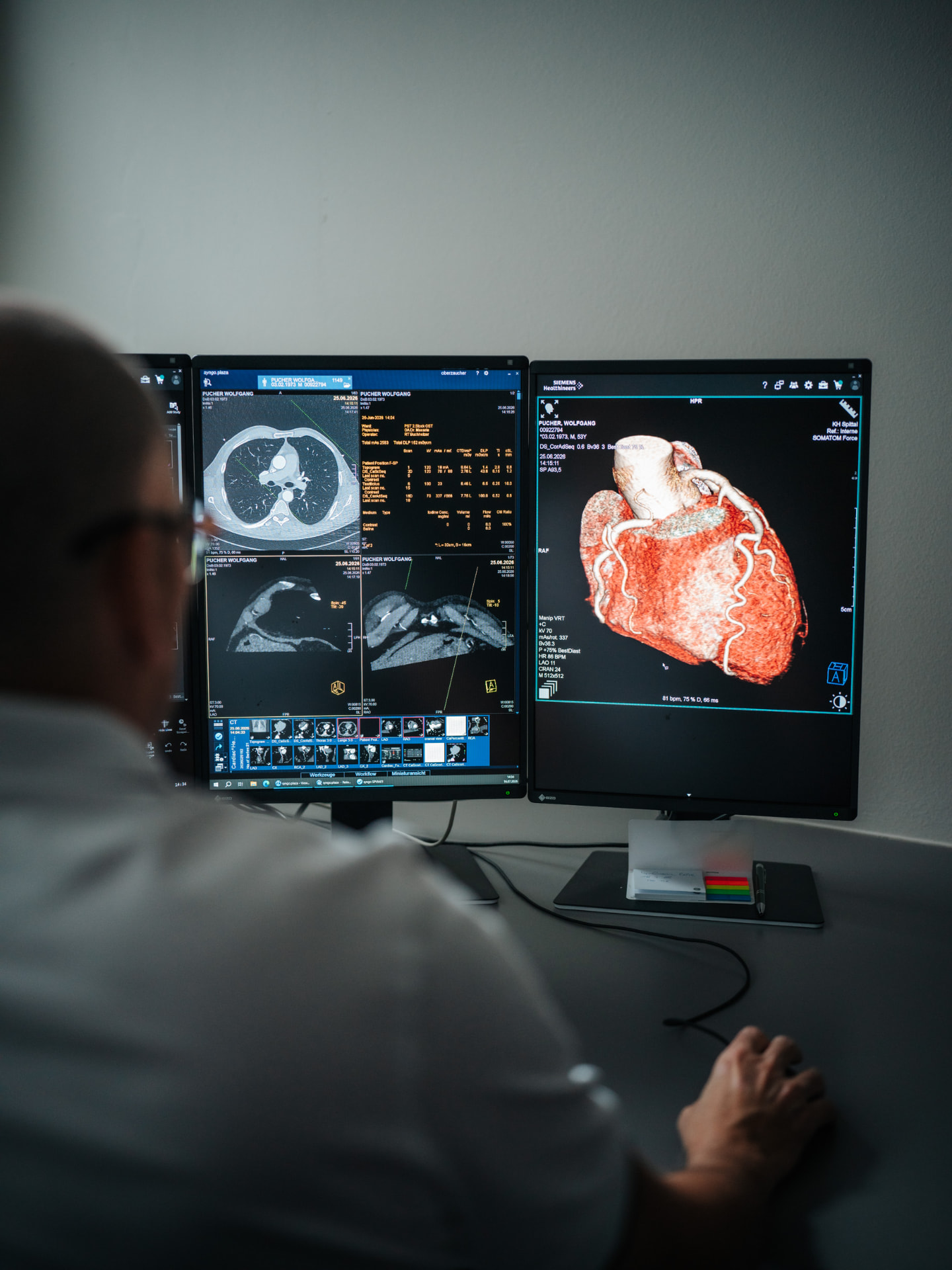 Herz-CT Befundung – 3D-Darstellung der Herzkranzgefäße am Siemens SOMATOM Force